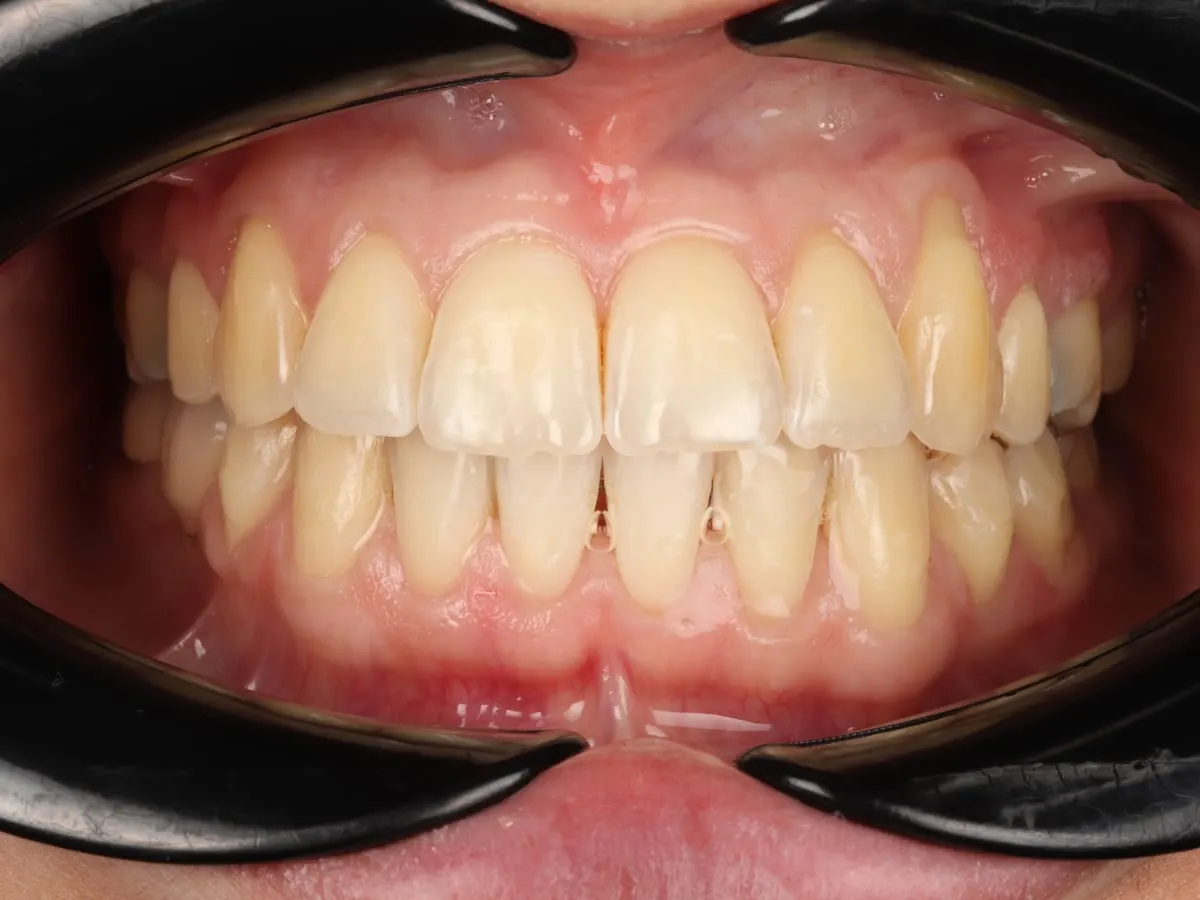 Clear Aligners - patient's teeth after treatment at Highview Dental Practice