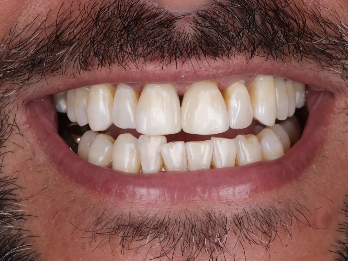 Composite Bonding - patient's teeth after treatment at Highview Dental Practice