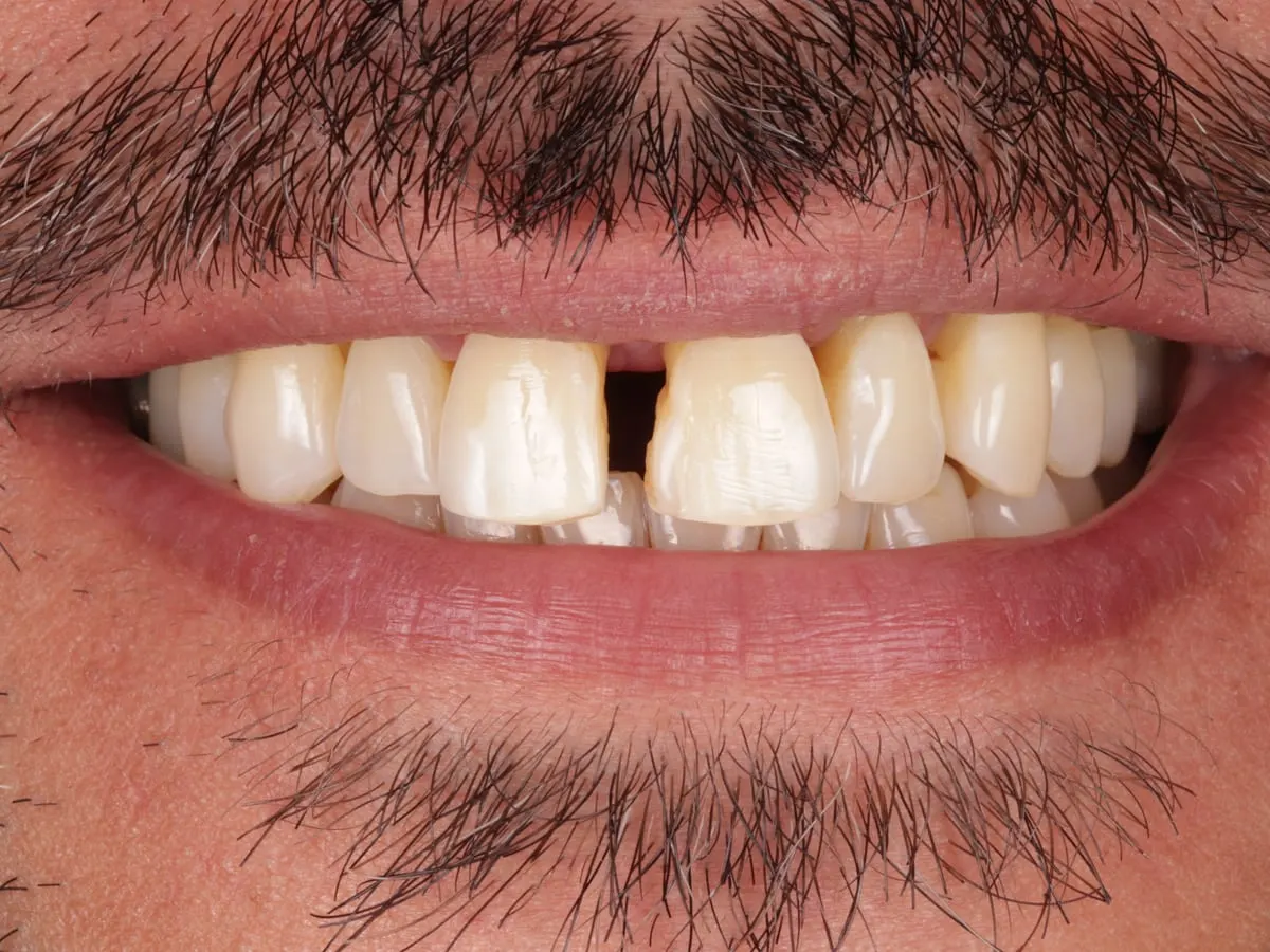 Composite Bonding - patient's teeth before treatment at Highview Dental Practice
