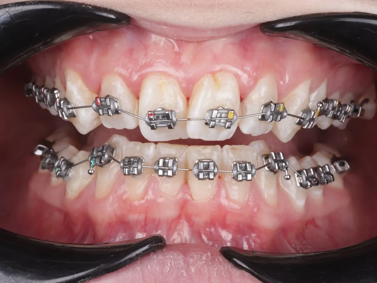 Fixed Braces - patient's teeth before treatment at Highview Dental Practice