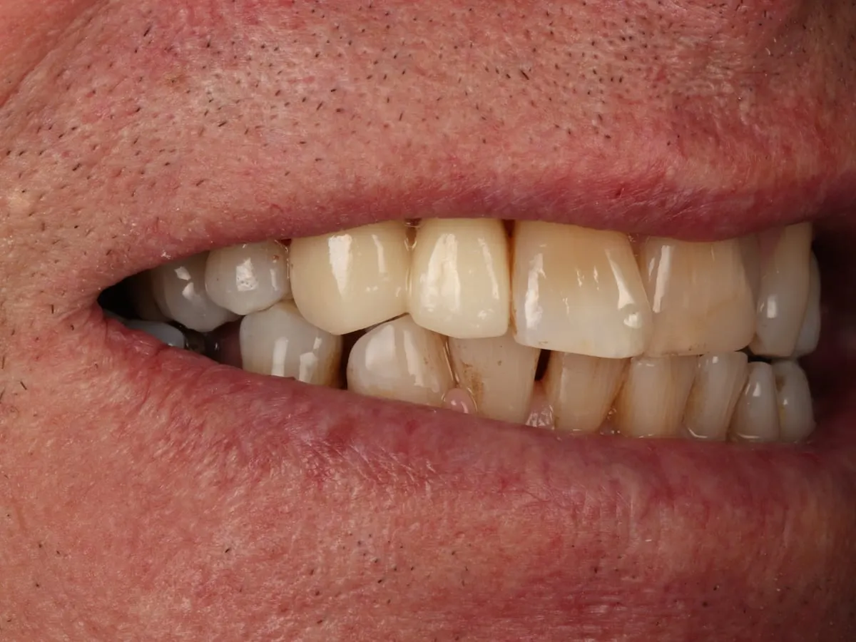 Dental Bridge - patient's teeth after treatment at Highview Dental Practice