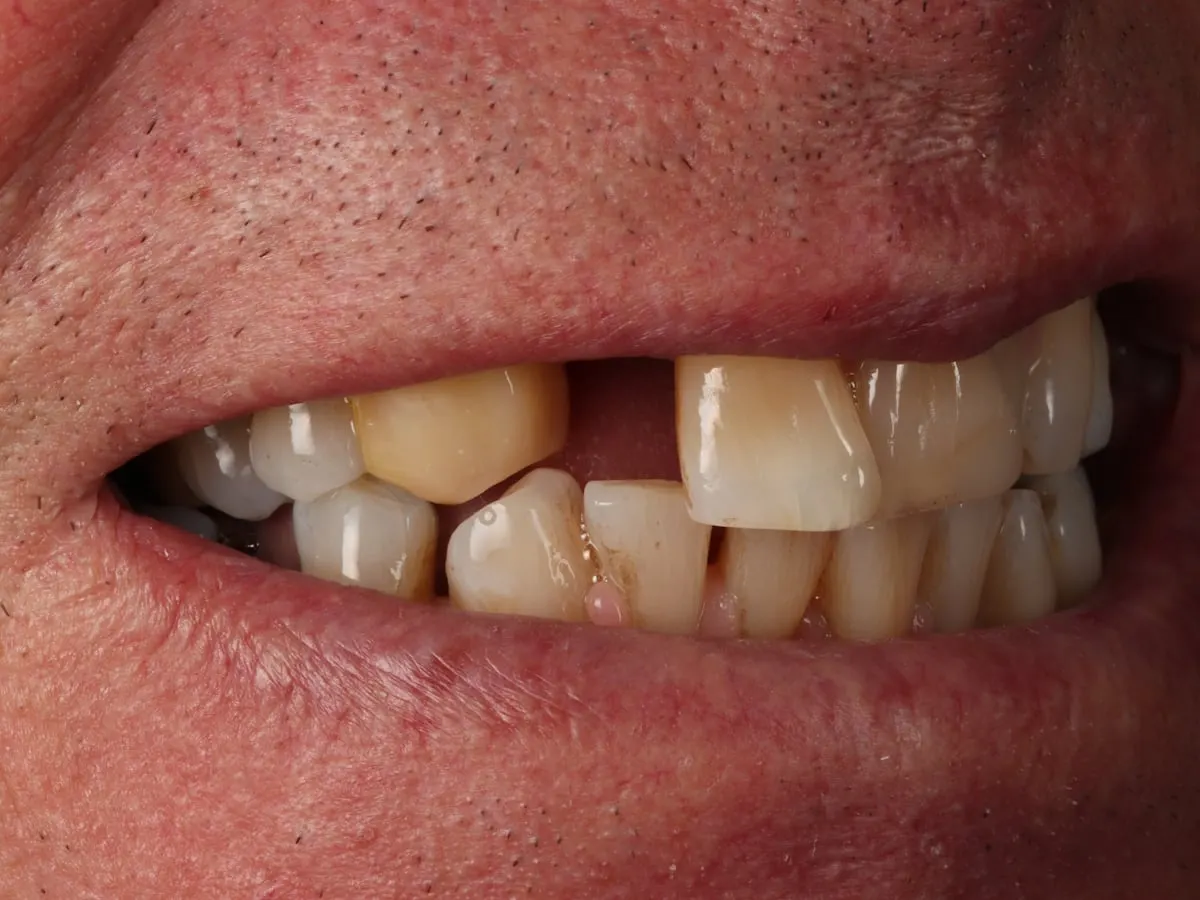 Dental Bridge - patient's teeth before treatment at Highview Dental Practice