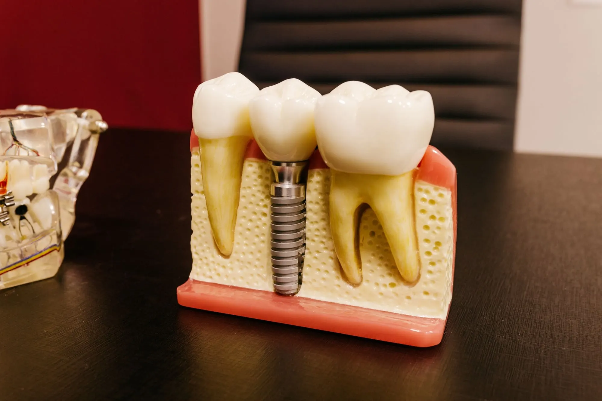 Model of a dental implant beside natural teeth
