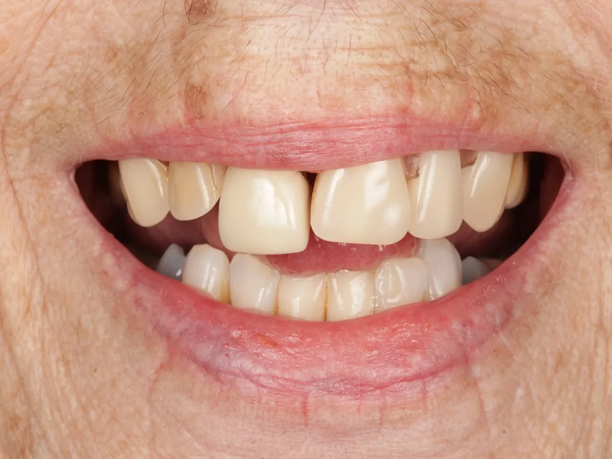 Dentures - patient's teeth before treatment at Highview Dental Practice
