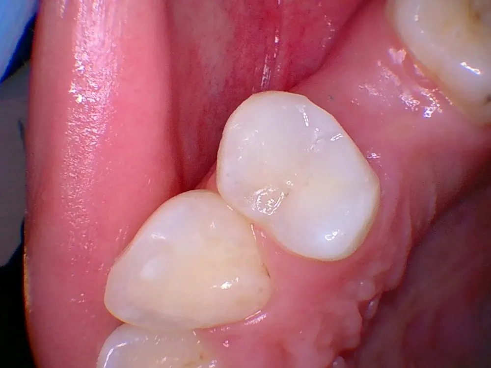 White Filling - patient's teeth after treatment at Highview Dental Practice