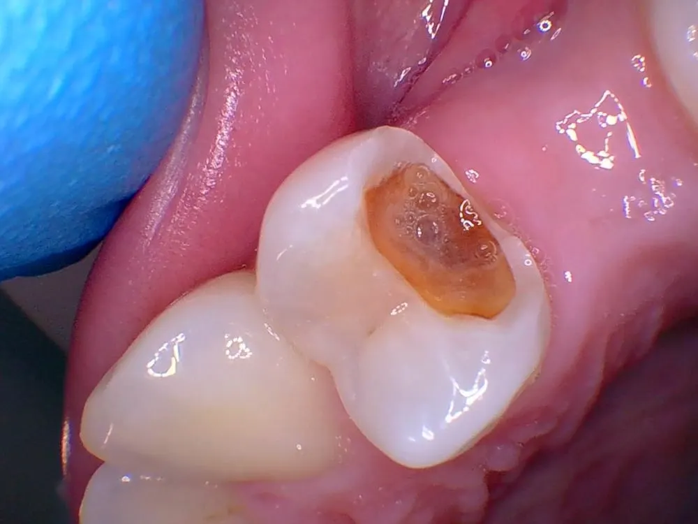 White Filling - patient's teeth before treatment at Highview Dental Practice