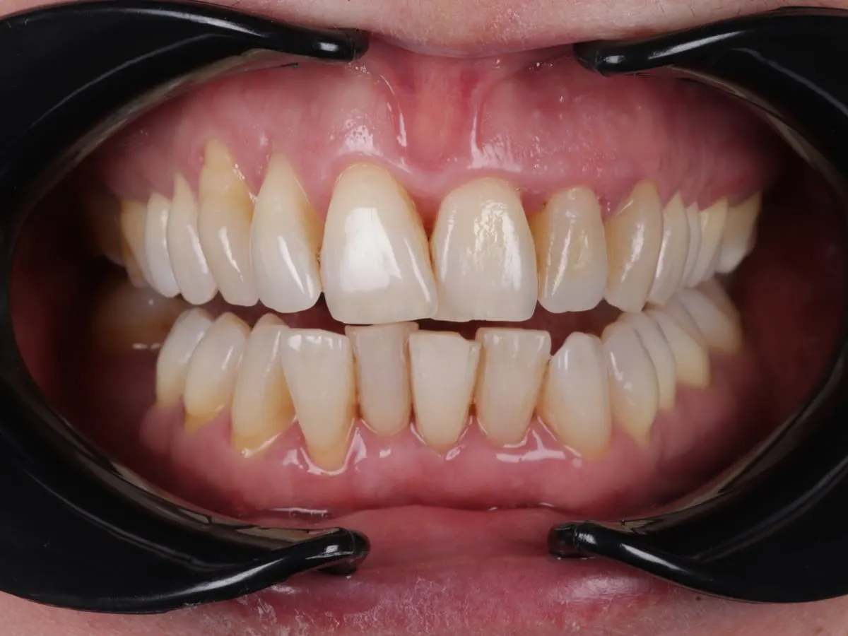 Gum Disease Treatment - patient's teeth after treatment at Highview Dental Practice