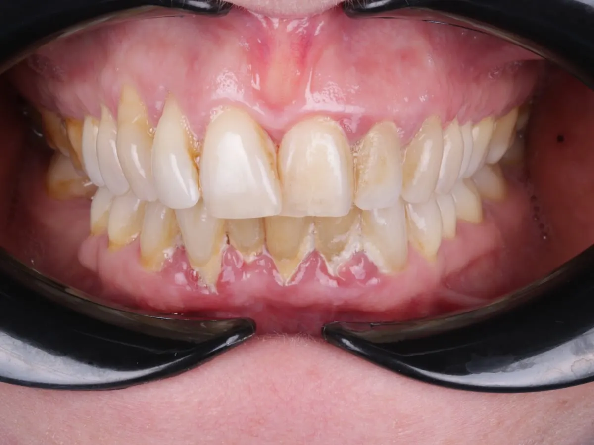Gum Disease Treatment - patient's teeth before treatment at Highview Dental Practice