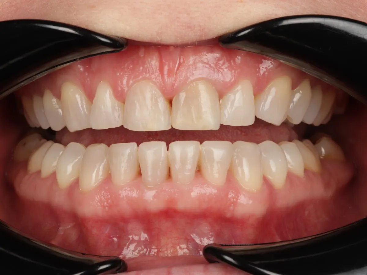 Smile Makeover - patient's teeth after treatment at Highview Dental Practice