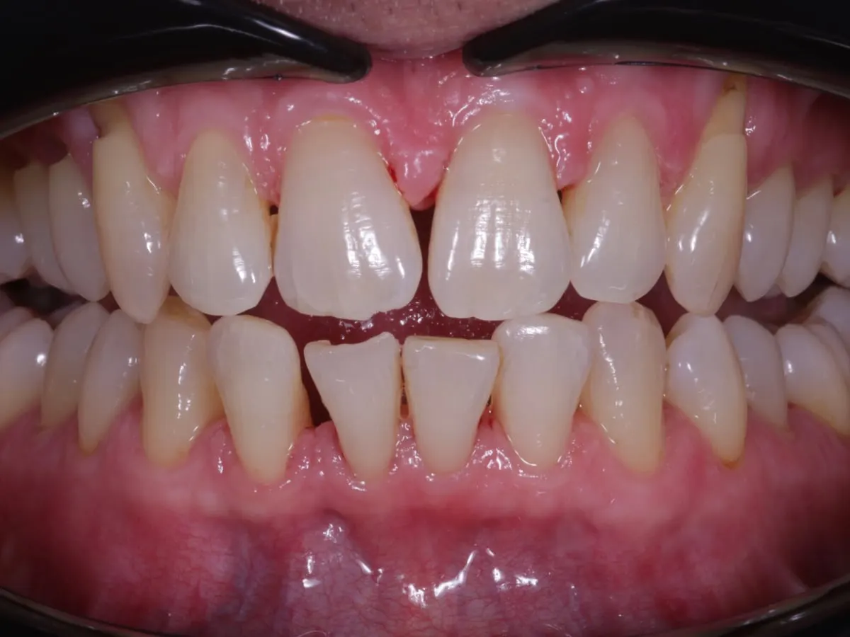 Stain Removal - patient's teeth after treatment at Highview Dental Practice