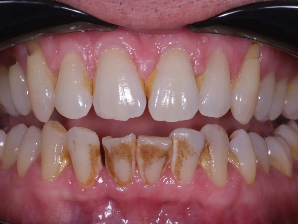 Stain Removal - patient's teeth before treatment at Highview Dental Practice