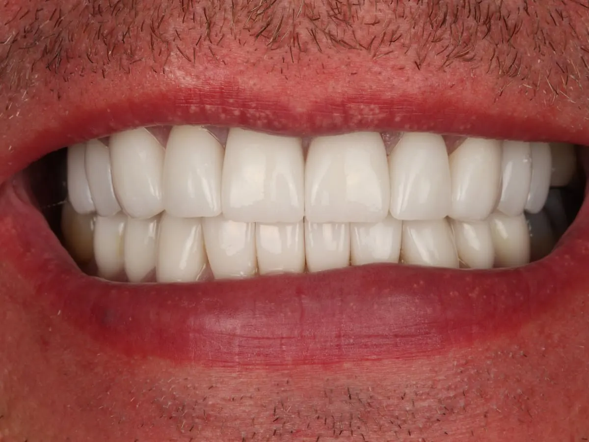 Veneers - patient's teeth after treatment at Highview Dental Practice