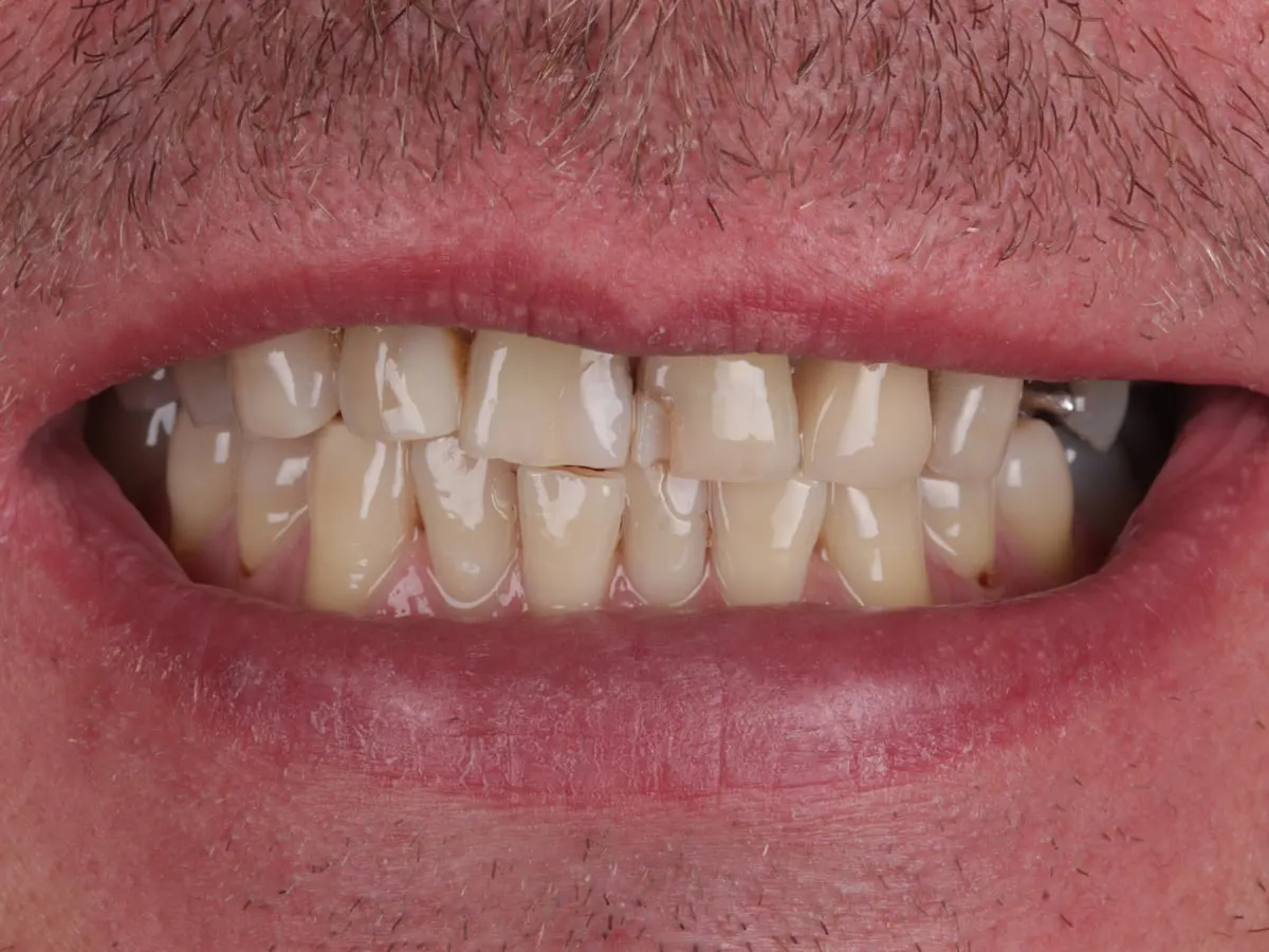 Veneers - patient's teeth before treatment at Highview Dental Practice