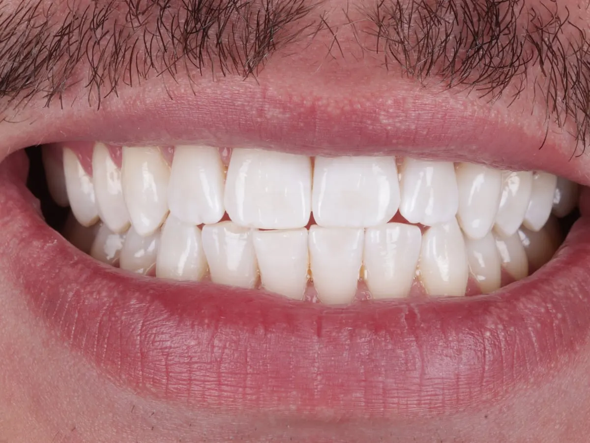 Teeth Whitening - patient's teeth after treatment at Highview Dental Practice
