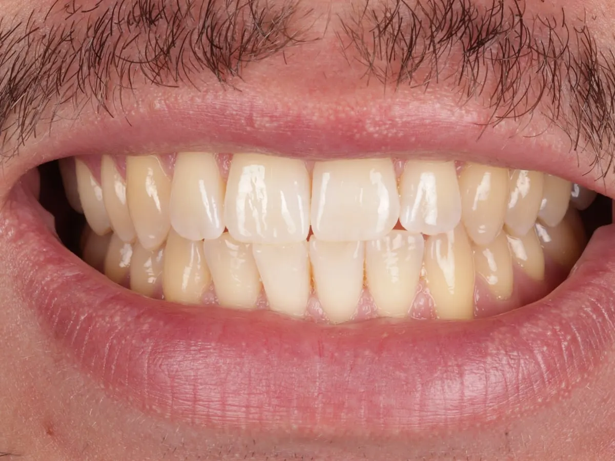 Teeth Whitening - patient's teeth before treatment at Highview Dental Practice
